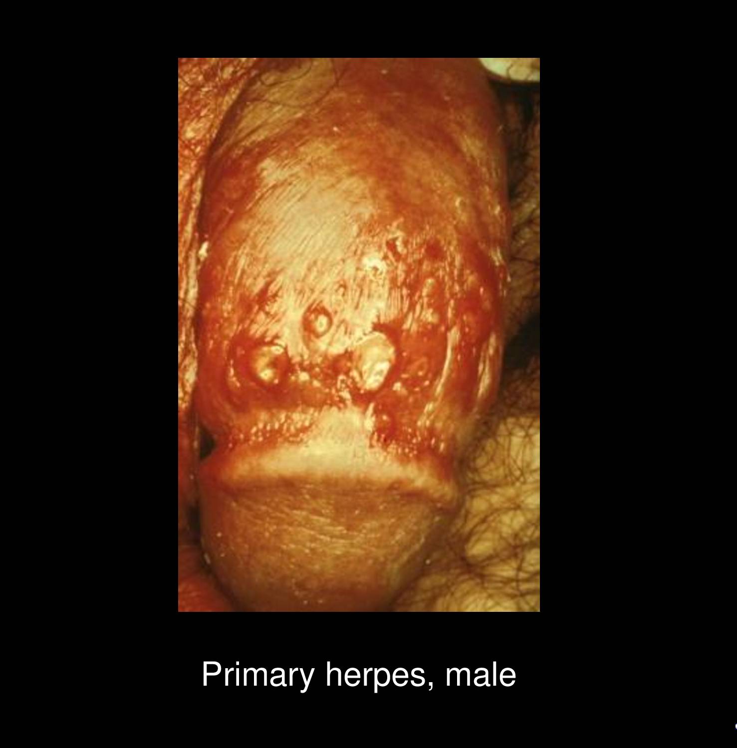 Genital herpes vesicular lesions on penile shaft showing clustered vesicles on erythematous base typical of HSV-2 infection diagnosed at STD Nepal